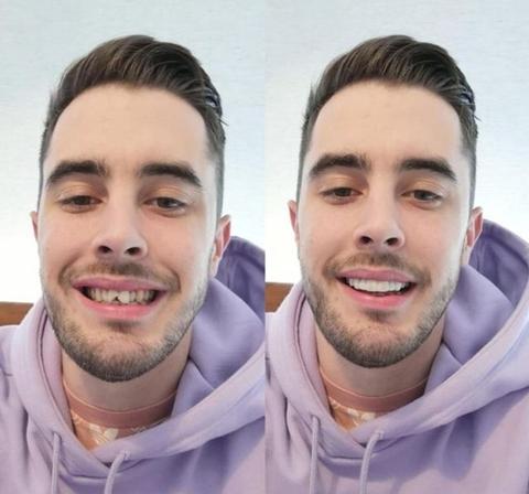 Brilliva - Sofortige Clip-On Zahnverblender für Ober- und Unterkieferzähne